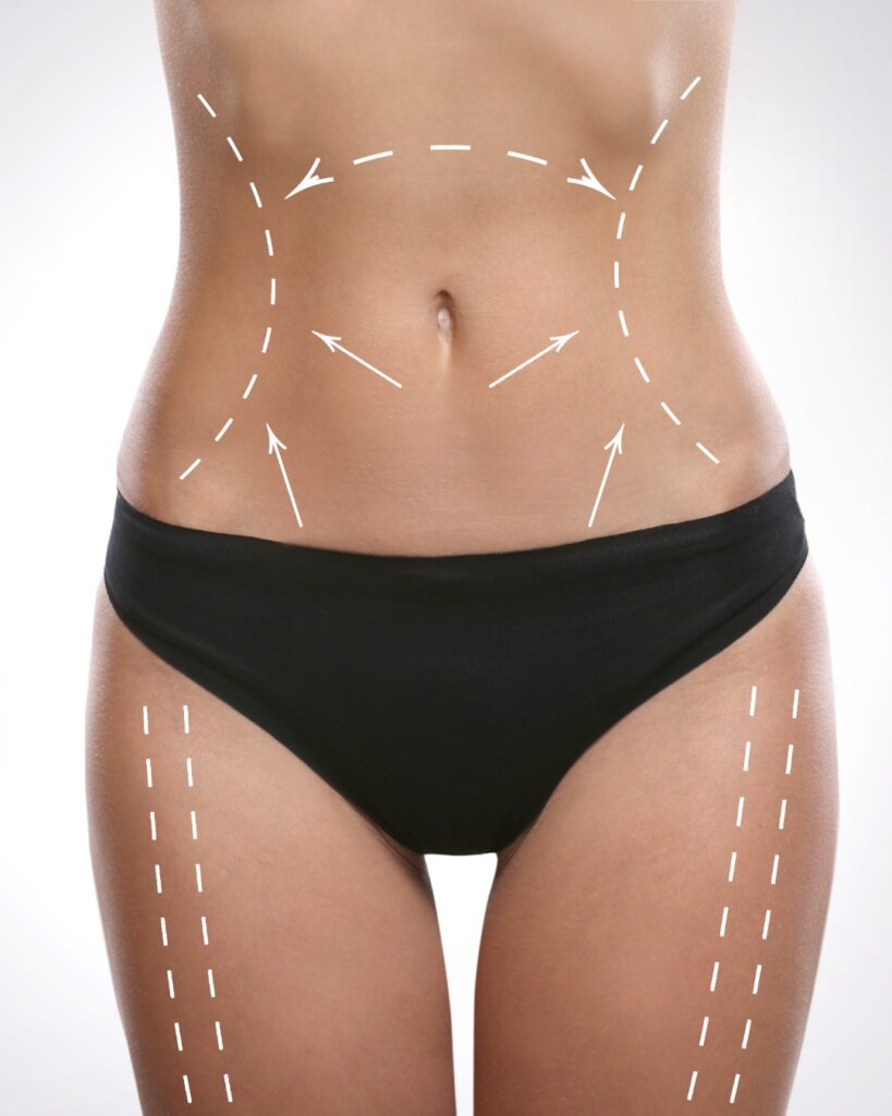 Kvinnelig kropp med perforering linjer for operasjon